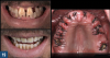 Fig 19. Left top panel: Pre-extraction situation. Left bottom panel:
Final result with immediate maxillary denture in place. Right panel:
Wound healing at 1 week following full-arch extractions and application of 10% carbamide peroxide (Pola Night, SDI).