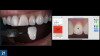 Fig 21. Left panel: Tooth shade assessment utilizing ceramic shade tabs and digital photography. Right panel: verification of the human perceived shade analysis from left panel utilizing a colorimeter.