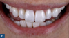 Fig 22. Seamless blend of full-contour zirconia crowns on an implant (tooth No. 8) and tooth with the natural adjacent dentition (tooth No. 9).