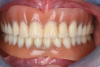 Fig 1. Intraoral view of existing mini-implant-retained dentures at patient presentation.