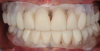 Fig 7. The new restorative set-up was 3D-printed in a split file: one file for the denture base and another for the teeth. This allowed the clinician to use clear resin at the base to determine the relationship of teeth to edentulous ridge and the need to use pink in the final prosthesis.