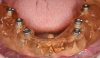 Fig 10. The surgical guide for the mandible was created to be supported by existing mini implants.
