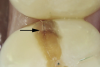 Fig 1. Decalcification in enamel along a crack line (arrow) and caries at the dentin-enamel junction of a mandibular left first molar (disto-occlusal view).