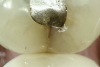 Fig 2. Asymptomatic enamel marginal ridge crack (arrow) of a mandibular left second molar with enamel ditching viewed under magnification by intraoral photography (mesio-occlusal view).