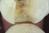 Fig 8. Complete removal of caries and crack elimination by fissurotomy in the tooth shown in Fig 7.