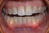 Fig 4. Following stain removal, clinical appearance is much improved. Note the absence of trauma to the marginal gingiva.