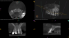 (2.) A radiograph of a root fracture associated with a threaded post, cone-beam computed tomography views of a perforation associated with a post, and a radiograph demonstrating evidence of apical leakage associated with posts, respectively.
