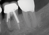 (3.) A radiograph of a root fracture associated with a threaded post, cone-beam computed tomography views of a perforation associated with a post, and a radiograph demonstrating evidence of apical leakage associated with posts, respectively.