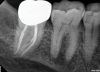 (4.) Radiographs of teeth treated with prefabricated and custom cast posts, respectively.