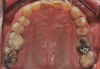 Fig 5. Pretreatment occlusal views: maxilla (Fig 5) and mandible (Fig 6).