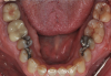 Fig 6. Pretreatment occlusal views: maxilla (Fig 5) and mandible (Fig 6).