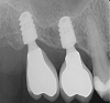 Fig 1. Use of short implants (6 mm length) to avoid a sinus graft augmentation.
