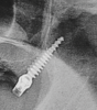 Fig 4. Radiograph showing a 3.5 mm x 20 mm pterygoid implant placed through the left maxillary tuberosity and engaging into the dense bone of the pterygoid plate.