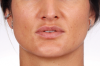 Fig 16. Preoperative frontal view showing lip posture and nasal alar base.