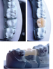 (2.) Occlusal and buccal views of a lithium disilicate glass-ceramic occlusal onlay on the model.