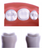 (3.) Examples of different preparation designs for partial-coverage restorations.