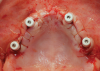 Fig 8. Final result with healing abutments.