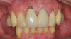 Fig 1. The patient’s clinical appearance pretreatment. The patient used maxillary and mandibular removable partial dentures to replace her missing posterior teeth.
