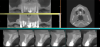Fig 3. Extensive bone loss was present around the maxillary anterior teeth.