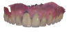 Fig 4. Intraoral surface scans with the patient’s removable partial denture in place; frontal view (Fig 4), and occlusal view (Fig 5).
