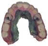 Fig 5. Intraoral surface scans with the patient’s removable partial denture in place; frontal view (Fig 4), and occlusal view (Fig 5).