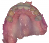 Fig 8. The supragingival margins can be clearly identified on the intraoral surface scan of the prepared abutment teeth.