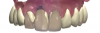 Fig 9. A virtual diagnostic wax-up for the restoration design was done replicating the patient’s previous restoration per the patient’s request; frontal view (Fig 9), and occlusal view (Fig 10). The white areas represent improved design.