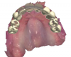 Fig 10. A virtual diagnostic wax-up for the restoration design was done replicating the patient’s previous restoration per the patient’s request; frontal view (Fig 9), and occlusal view (Fig 10). The white areas represent improved design.