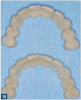 Fig 15. Both the zirconia (top) and PMMA (bottom) provisional restorations were made from the same manufacturing file.