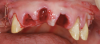 Fig 17. After completion of sinus grafting, the individual provisional restorations were removed and all maxillary teeth that were not to be used to support the provisional restoration were extracted.