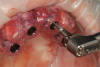 Fig 18. A fully guided drilling sequence, including implant insertion, was performed.