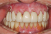 Fig 23. At 2 weeks postoperatively, the soft tissue was healing nicely around the zirconia provisional.