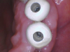 (2.) Intraoral camera view of custom contoured healing abutments placed to establish an ideal emergence profile.