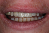 (14.) Postoperative smile photograph. Note the ideal amount of tooth display that was achieved and how the final restorations blend excellently with the surrounding dentition.