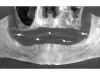 Fig 1. Preoperative CBCT panoramic view.