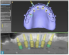 Fig 2. Implant planning for the maxillary arch for the patient of Case Study 1.
