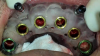 Fig 4. Maxillary surgical guide stabilized with anchor pins.