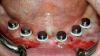 Fig 9. Undercuts blocked using the block-out spacer and fixed locator housings placed over the conventional locator abutments.