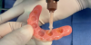Fig 10. Pick-up material placed in the recesses of the denture.