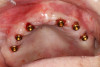 Fig 22. Conventional locator abutments attached to the implants.