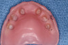 Fig 23. Denture relieved in the location of the implant abutments and relined with a soft lining material.