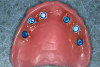 Fig 25. Denture attachment housings picked up in the prosthesis.