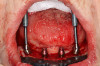 Fig 27. Multi-unit angle correction abutments attached to the tilted posterior implants.