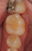 Fig 2. Tooth No. 19 at presentation, occlusal view. Note the thickness of the soft tissue and width of keratinized tissue.