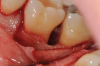 Fig 5. Surgical access and root preparation. The flaps were elevated after intrasulcular incisions were made and a releasing incision was done in the mesial aspect of tooth No. 19. The granulation tissue was removed.