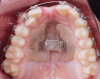 Fig 10. After the transverse expansion was completed, the expander was stabilized, and orthodontic correction with fixed appliances may be performed.