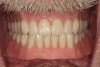 Fig 1. Patient presented wearing soft relined immediate dentures.