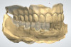 Fig 10. A technician superimposed the scan of the arch with scan bodies onto the scan of the relined denture using a dental laboratory software.