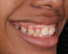 (3.) Pretreatment smile, left lateral smile, and right lateral smile photographs, respectively, showing the patient’s peg-shaped lateral incisors.