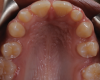 (4.) Pretreatment retracted occlusal photograph showing the multiple diastemas.